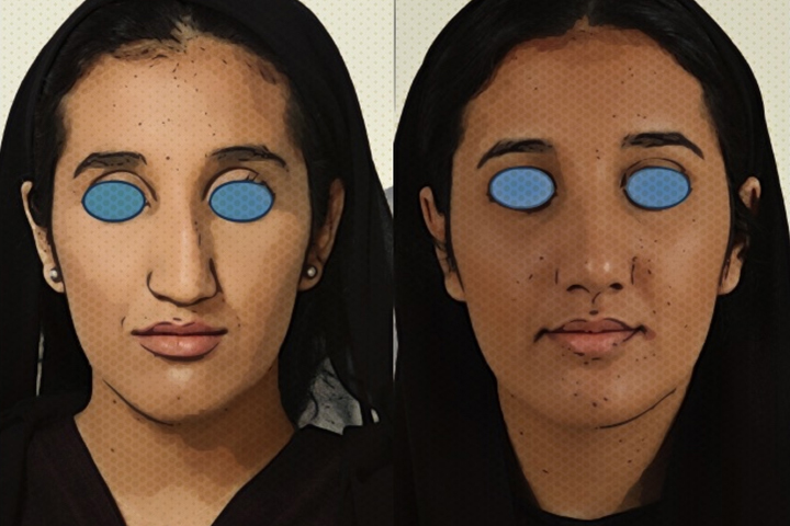 Rhinoplasty Patient 4 - Dr. Aly in Dallas Texas - Before and After Patient View 1