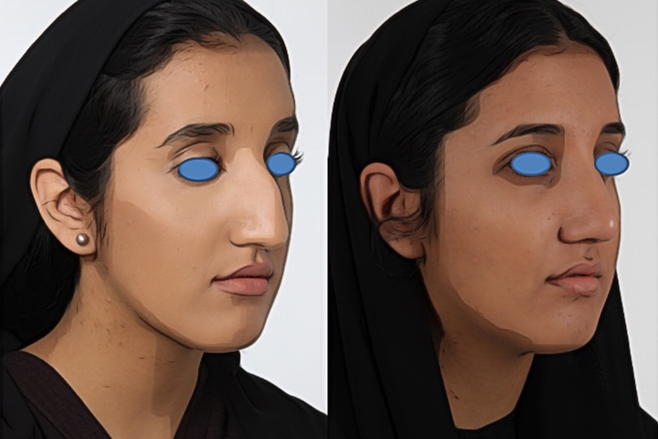 Rhinoplasty Patient 4 - Dr. Aly in Dallas Texas - Before and After Patient View 2