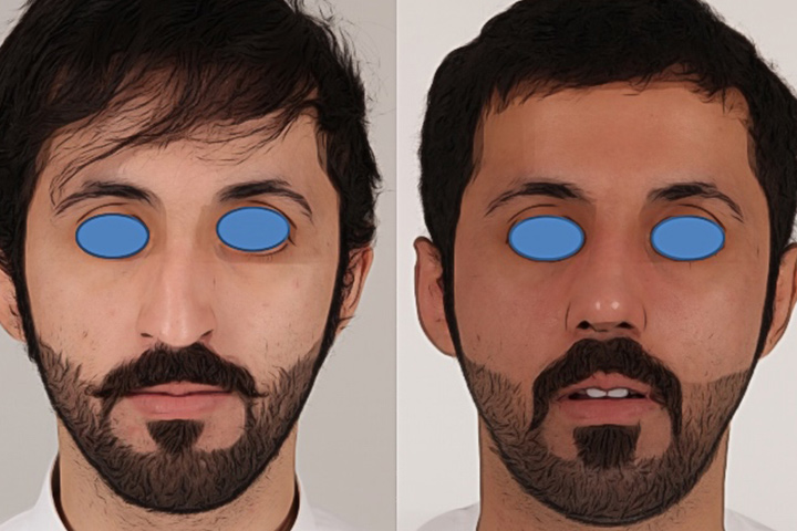 Rhinoplasty Patient 6 - Dr. Aly in Dallas Texas - Before and After Patient View 1