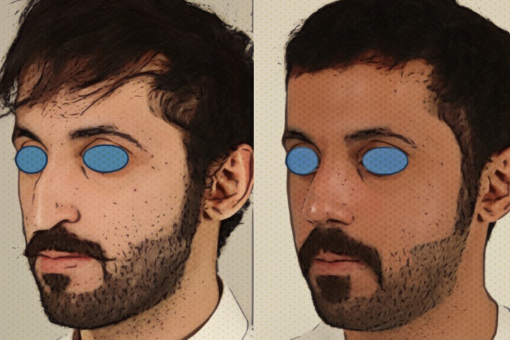 Rhinoplasty Patient 6 - Dr. Aly in Dallas Texas - Before and After Patient View 2