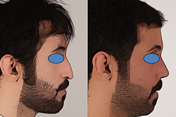 Rhinoplasty Patient 6 - Dr. Aly in Dallas Texas - Before and After Patient View 3