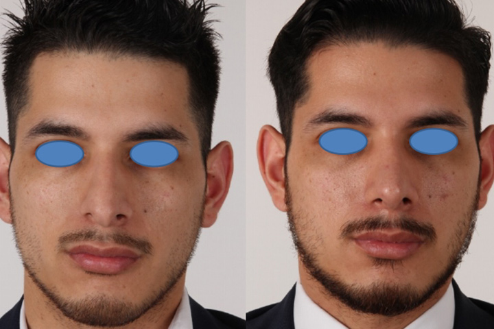Rhinoplasty Patient 9 - Dr. Aly in Dallas Texas - Before and After Patient View 1
