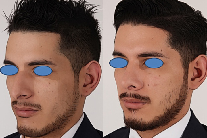 Rhinoplasty Patient 9 - Dr. Aly in Dallas Texas - Before and After Patient View 2