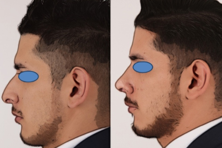 Rhinoplasty Patient 9 - Dr. Aly in Dallas Texas - Before and After Patient View 3