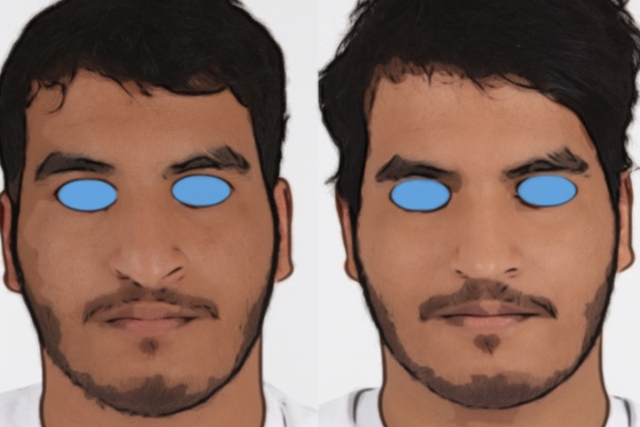 Rhinoplasty Patient 10 - Dr. Aly in Dallas Texas - Before and After Patient View 1