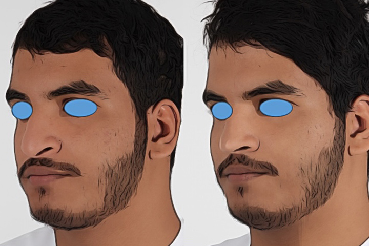Rhinoplasty Patient 10 - Dr. Aly in Dallas Texas - Before and After Patient View 2