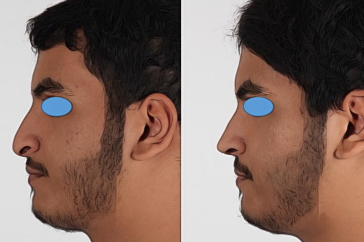 Rhinoplasty Patient 10 - Dr. Aly in Dallas Texas - Before and After Patient View 3
