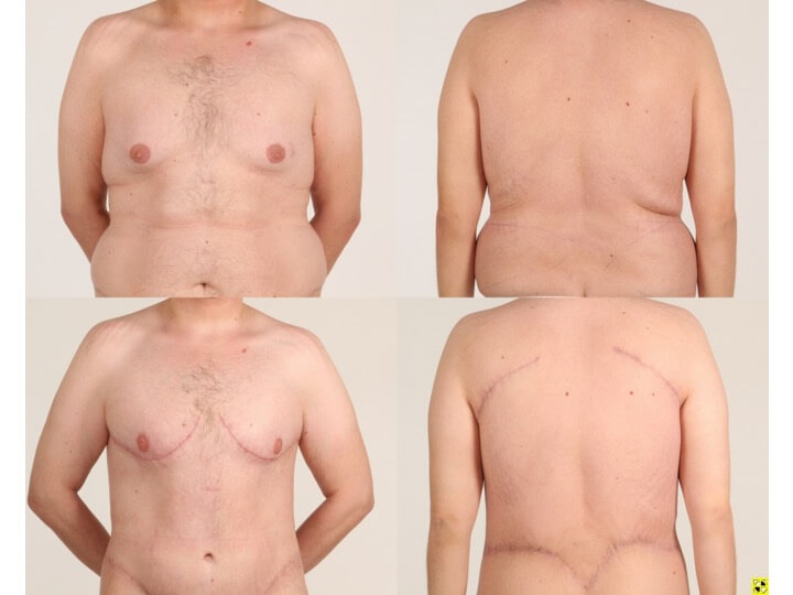 Upper Body Lift Patient 1 - Dr. Aly in Dallas Texas - Before and After Patient View 1