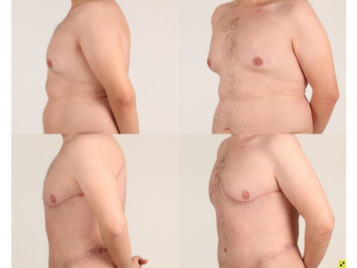 Upper Body Lift Patient 1 - Dr. Aly in Dallas Texas - Before and After Patient View 2