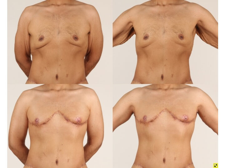 Thumbnail Upper Body Lift Patient 10 - Dr. Aly in Dallas Texas - Before and After Patient View 1