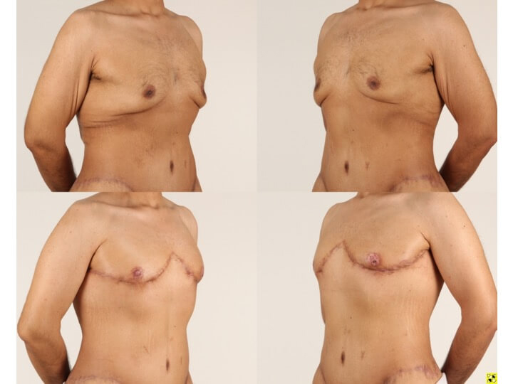 Upper Body Lift Patient 10 - Dr. Aly in Dallas Texas - Before and After Patient View 2