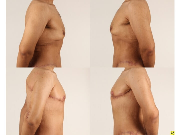 Upper Body Lift Patient 10 - Dr. Aly in Dallas Texas - Before and After Patient View 3
