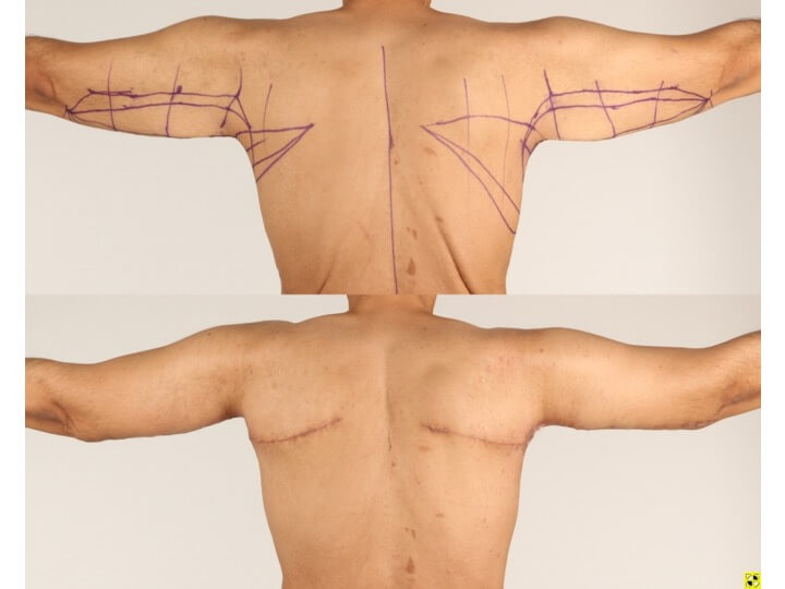 Upper Body Lift Patient 10 - Dr. Aly in Dallas Texas - Before and After Patient View 4