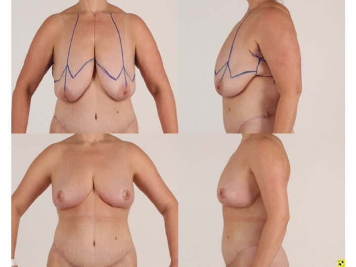 Upper Body Lift Patient 12 | Before and After Upper Body Lift 1