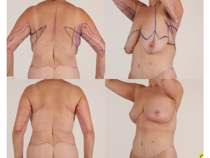 Upper Body Lift Patient 12 | Before and After Upper Body Lift 2