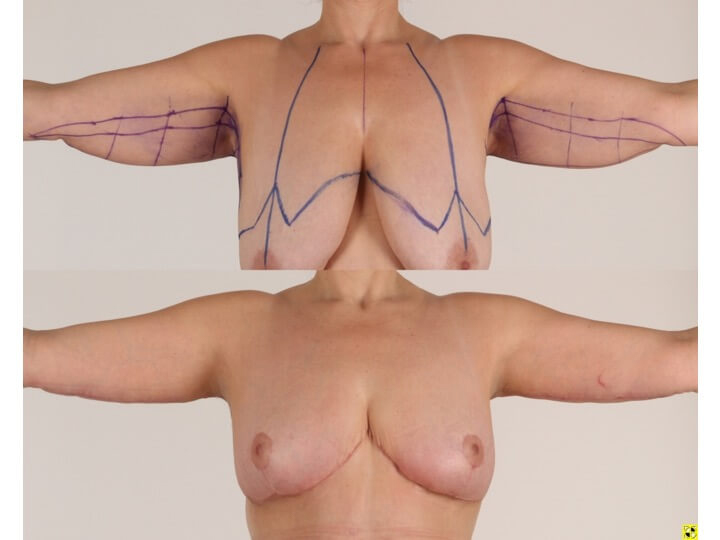 Upper Body Lift Patient 12 | Before and After Upper Body Lift 3