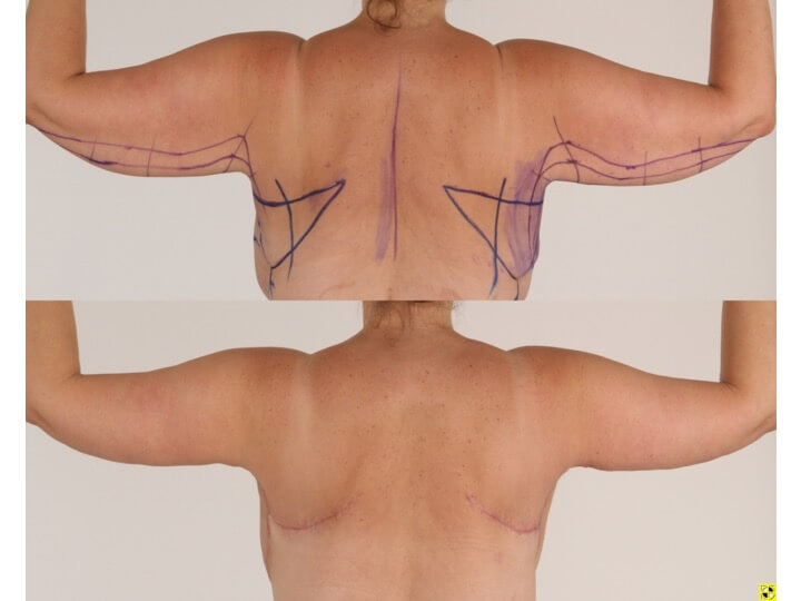 Upper Body Lift Patient 12 | Before and After Upper Body Lift 4