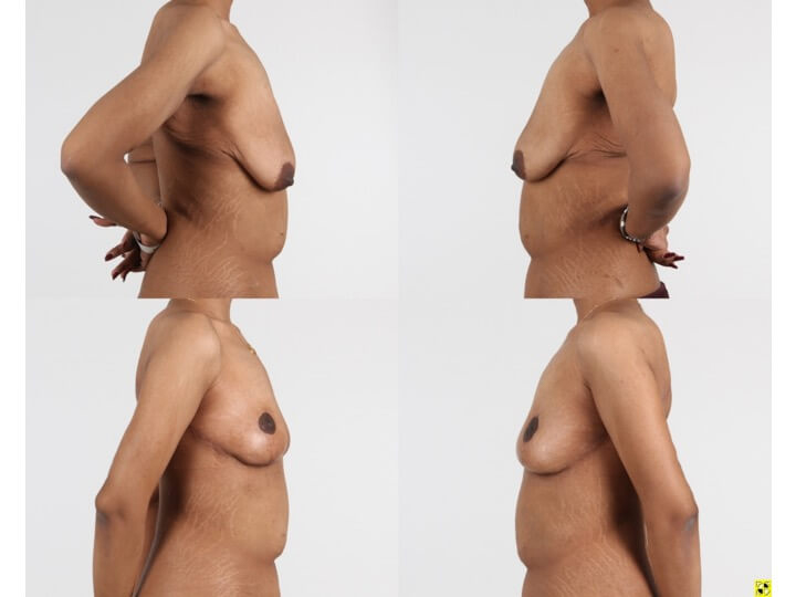 Upper Body Lift Patient 13 | Before and After Upper Body Lift 4