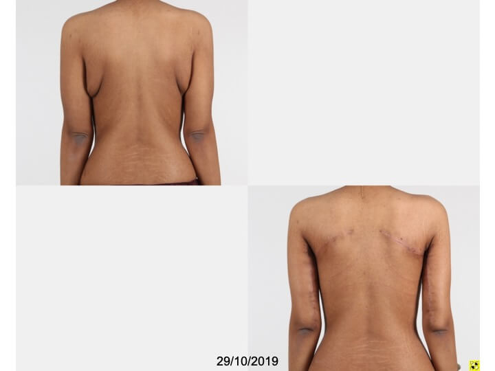 Upper Body Lift Patient 13 | Before and After Upper Body Lift 3