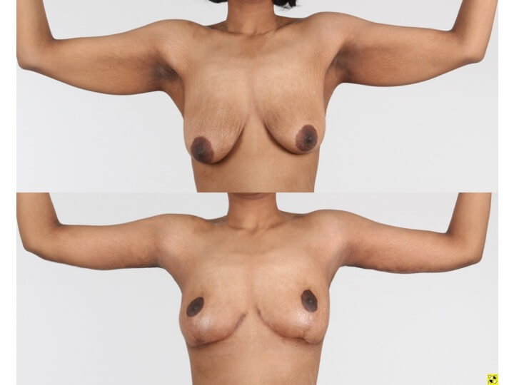 Upper Body Lift Patient 13 | Before and After Upper Body Lift 2