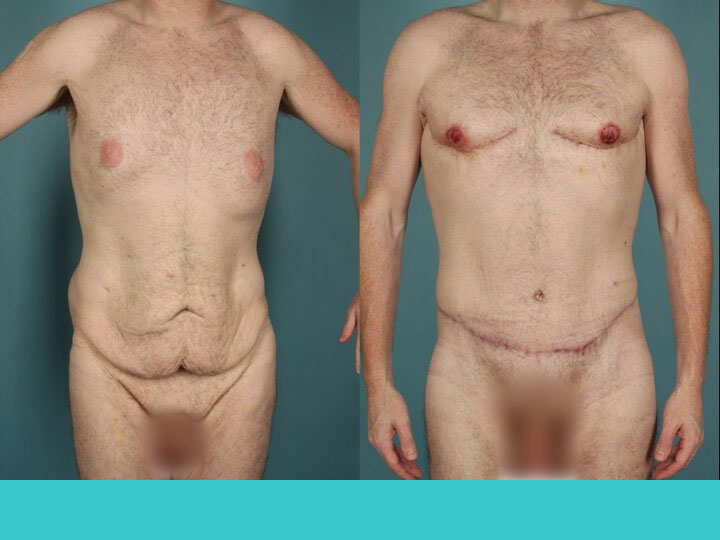Upper Body Lift Patient 18 | Before and After Upper Body Lift 1