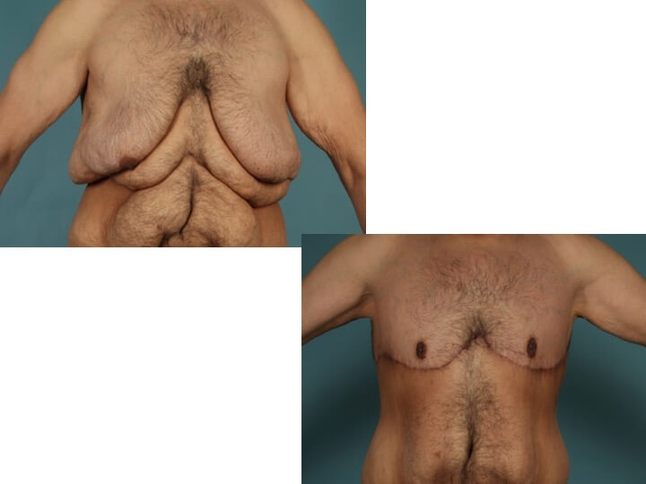 Upper Body Lift Patient 11 - Dr. Aly in Dallas Texas - Before and After Patient View 2