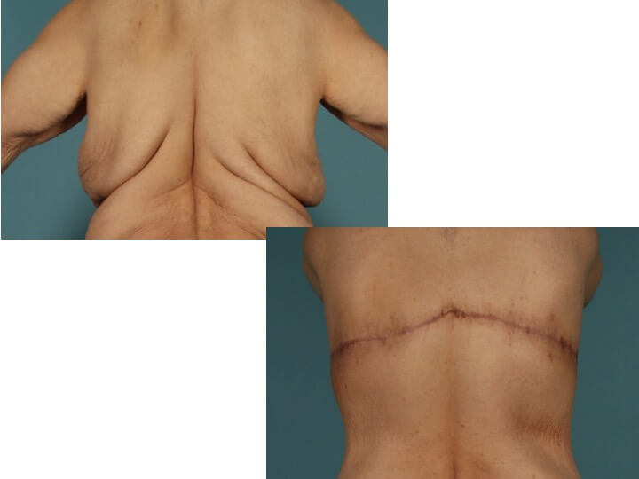 Upper Body Lift Patient 11 - Dr. Aly in Dallas Texas - Before and After Patient View 3