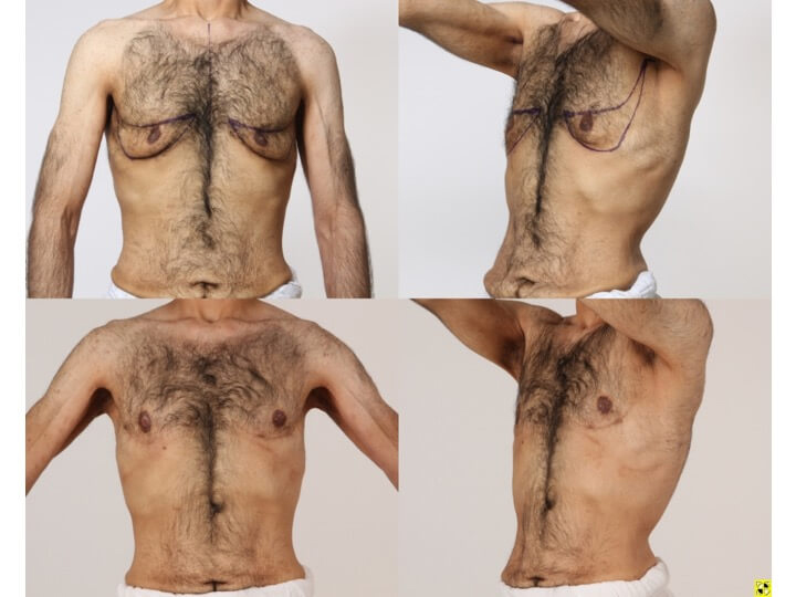 Upper Body Lift Patient 2 - Dr. Aly in Dallas Texas - Before and After Patient View 1