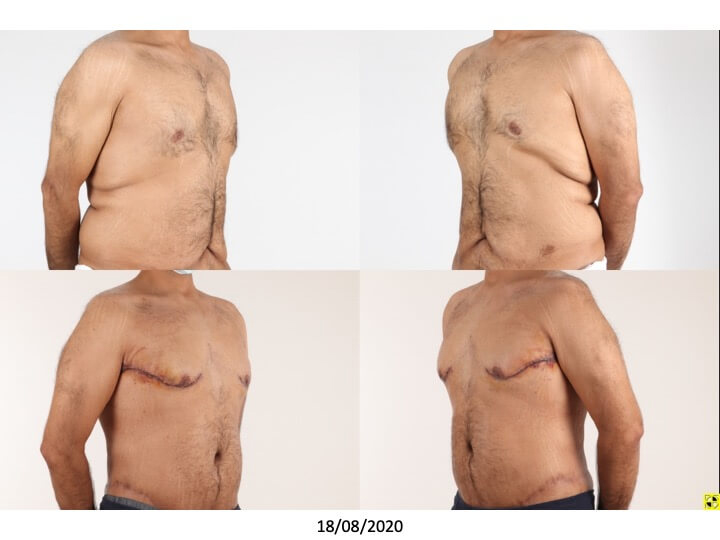Upper Body Lift Patient 3 - Dr. Aly in Dallas Texas - Before and After Patient View 2