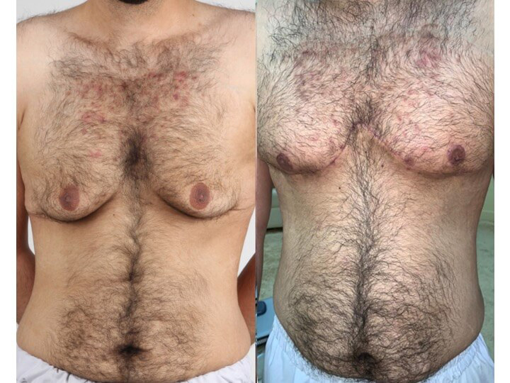 Upper Body Lift Patient 4 - Dr. Aly in Dallas Texas - Before and After Patient View 1
