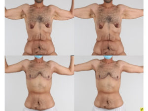Upper Body Lift Before and After Patient Thumbnail 1
