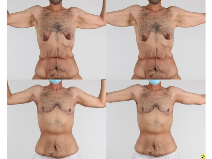Upper Body Lift Before and After Patient 1
