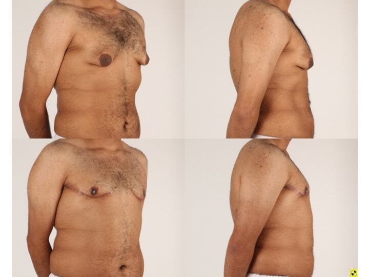 Upper Body Lift Patient 5 - Dr. Aly in Dallas Texas - Before and After Patient View 2