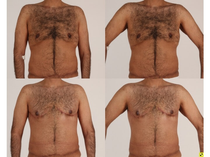 Upper Body Lift Patient 7 - Dr. Aly in Dallas Texas - Before and After Patient View 1