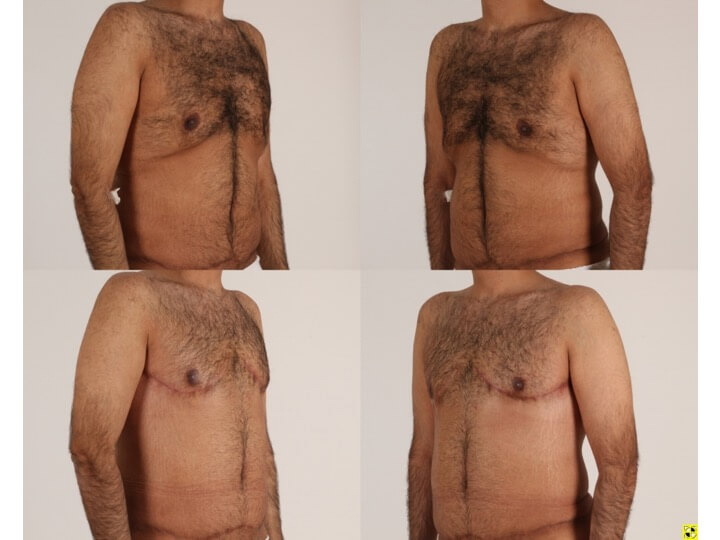 Upper Body Lift Patient 7 - Dr. Aly in Dallas Texas - Before and After Patient View 2