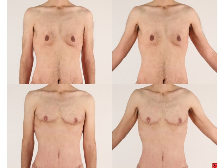 Upper Body Lift Patient 8 - Dr. Aly in Dallas Texas - Before and After Patient View 1