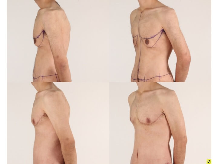 Upper Body Lift Patient 8 - Dr. Aly in Dallas Texas - Before and After Patient View 2