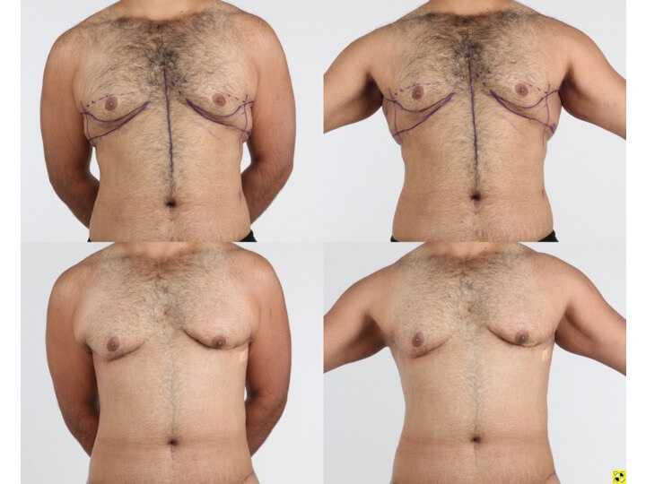Upper Body Lift Patient 9 - Dr. Aly in Dallas Texas - Before and After Patient View 1