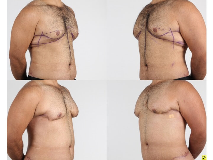 Upper Body Lift Patient 9 - Dr. Aly in Dallas Texas - Before and After Patient View 2