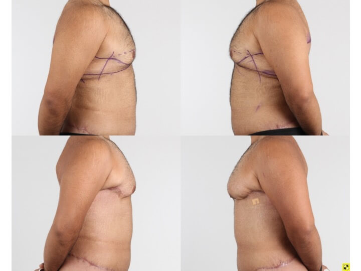 Upper Body Lift Patient 9 - Dr. Aly in Dallas Texas - Before and After Patient View 3