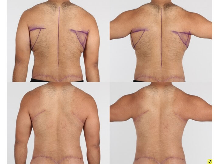 Upper Body Lift Patient 9 - Dr. Aly in Dallas Texas - Before and After Patient View 4